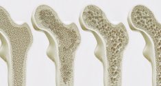Blocking Estrogen Receptors in Brain Boosts Bone Mass