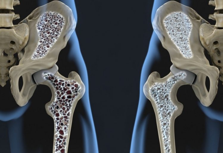 New Science Validates Link Between Drinking Soda and Osteoporosis 2