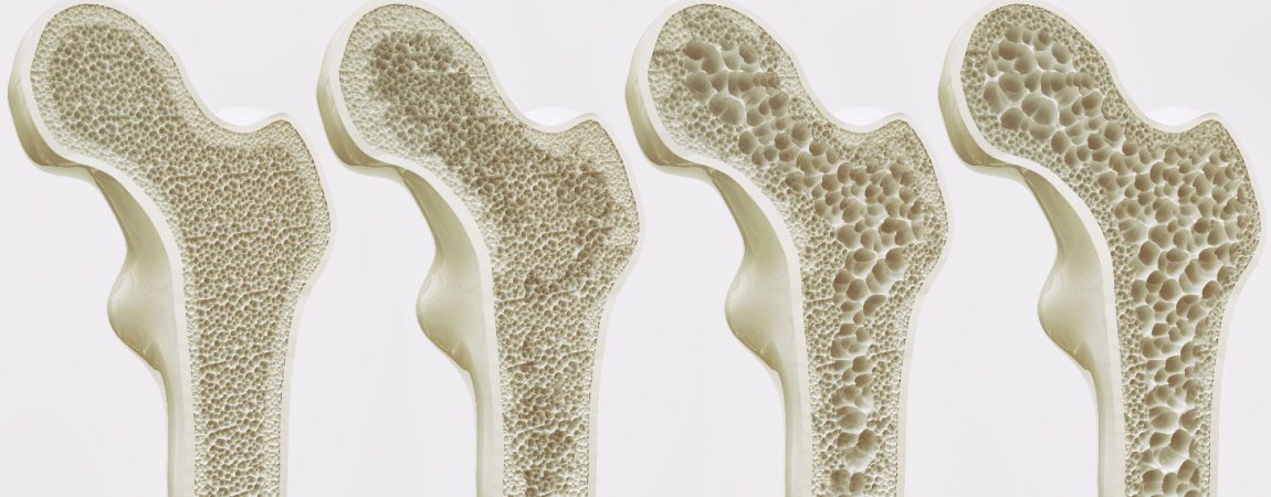 Osteoporosis: Strategies for Maintaining Healthy Bones